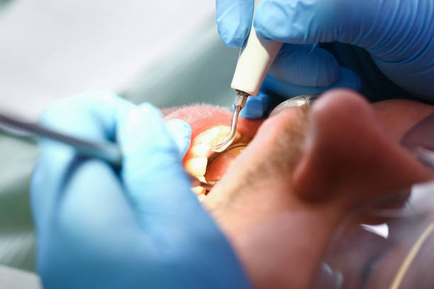 Best Knocked-Out Tooth (Avulsed Tooth) Treatment in Elgin, OK