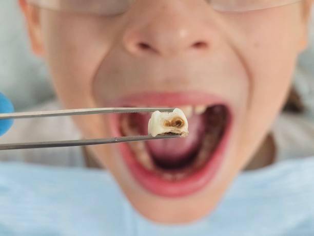 Best Emergency Wisdom Tooth Extraction in Elgin, OK